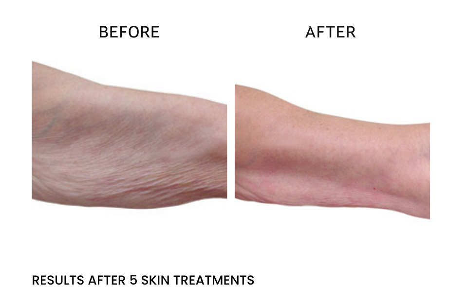 Before after upper arms MP2 skin tightening tor improvement of skin elasticity