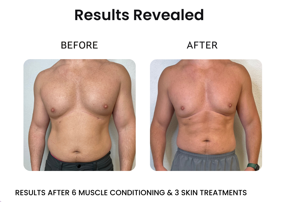 body sculpting before after of man's chest
