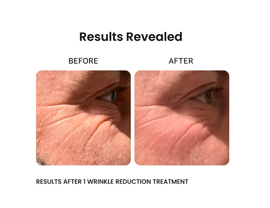 before and after results of venus versa pro wrinkle reduction technology showing wrinkle eye reduction