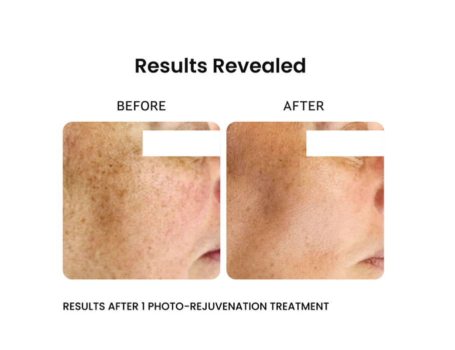 before and after results of venus versa pro ipl photorejuvenation showing skin tone