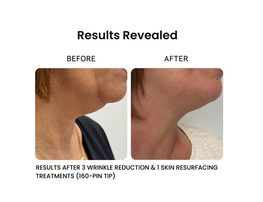 before and after results of venus versa pro skin resurfacing showing wrinkle reduction
