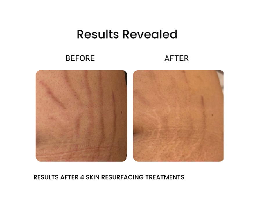 before and after VivaMD skin resurfacing