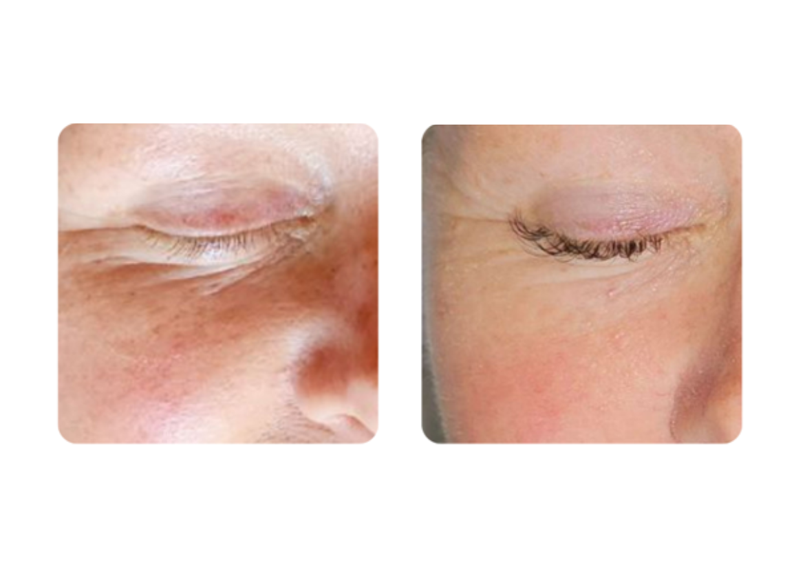 versa pro before and after