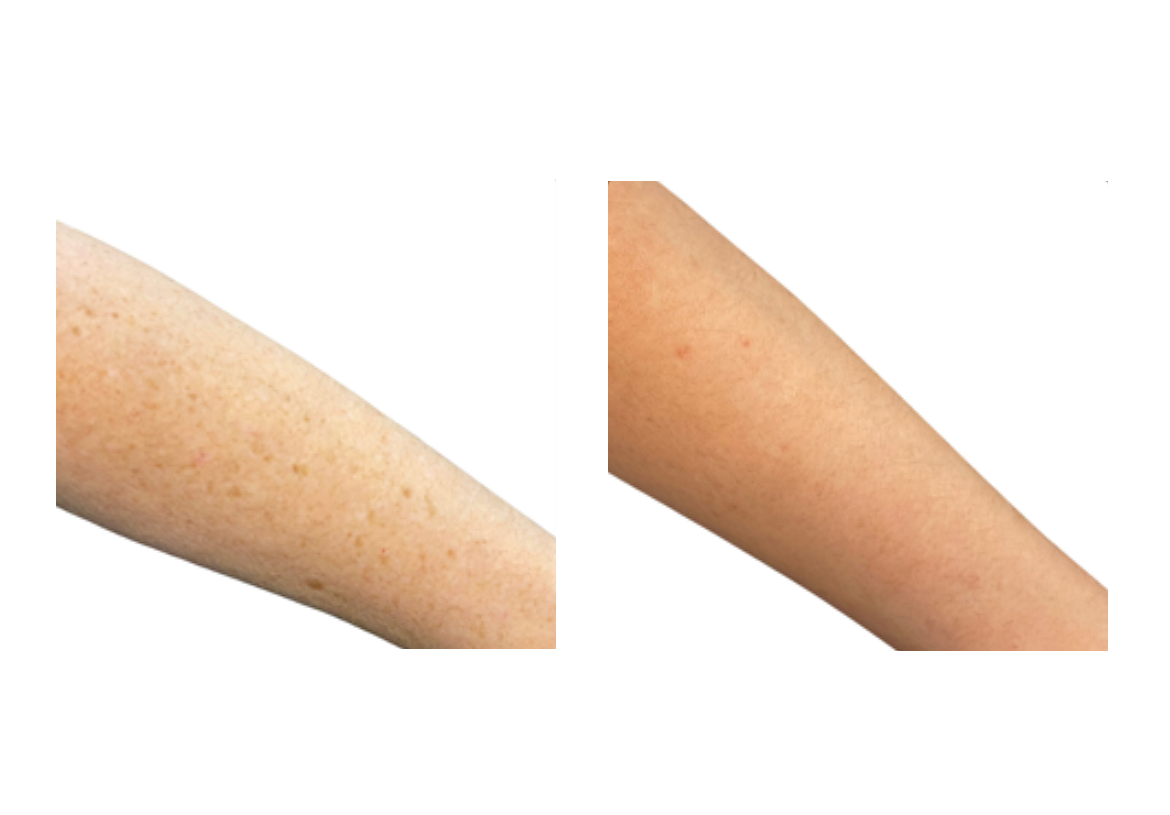 versa pro before and after