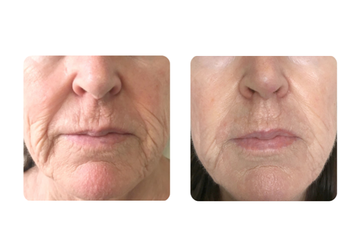 versa pro before and after