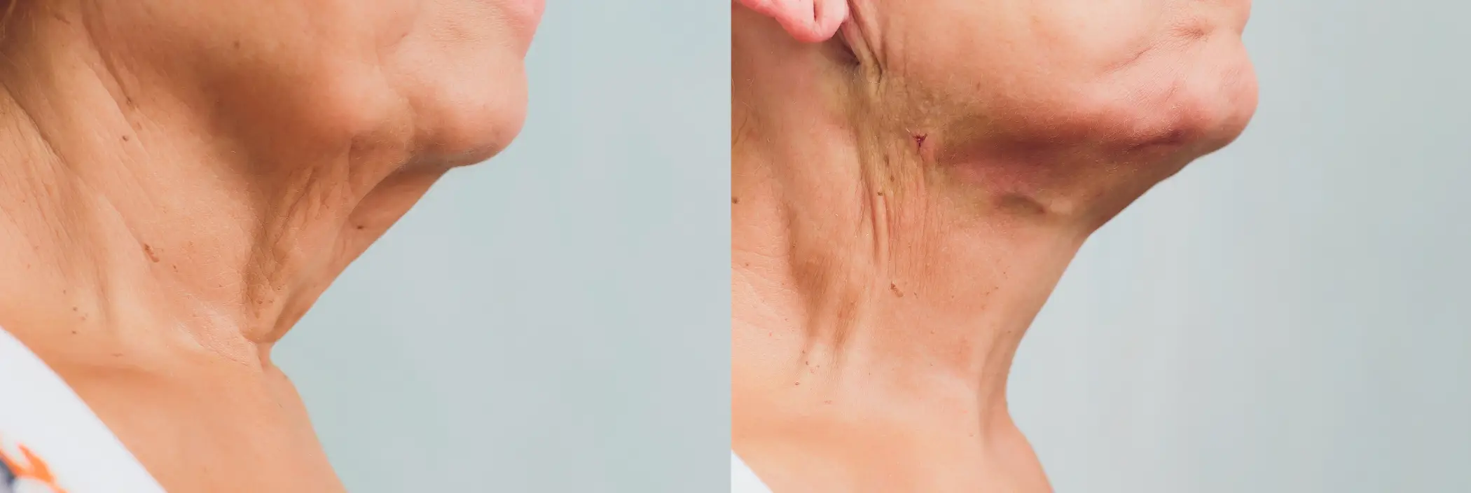 benefits of smooth PDO threads for volume loss mild skin laxity skin texture and collagen production